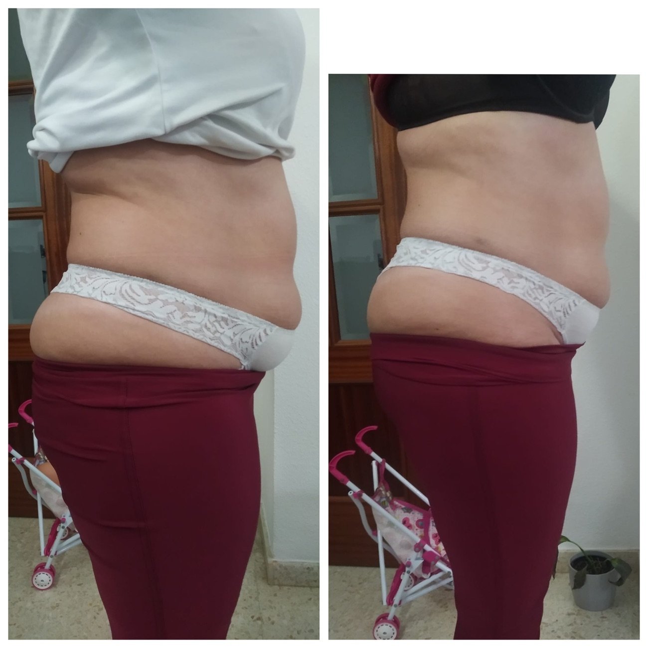 Resultado de drenaje y reafirmante corporal