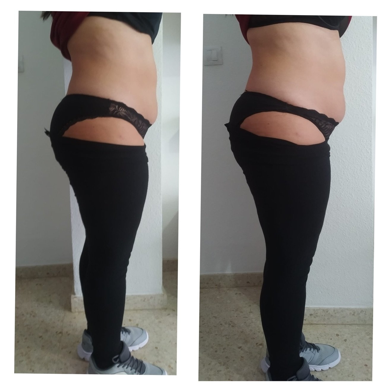 Reducción de volumen de perfil tras el tratamiento